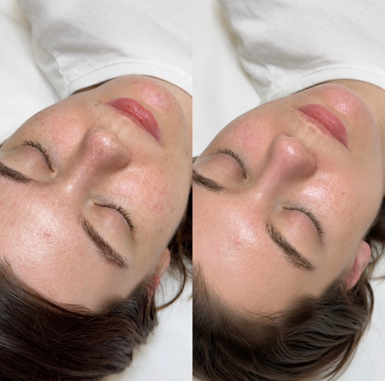 Hydrafacial