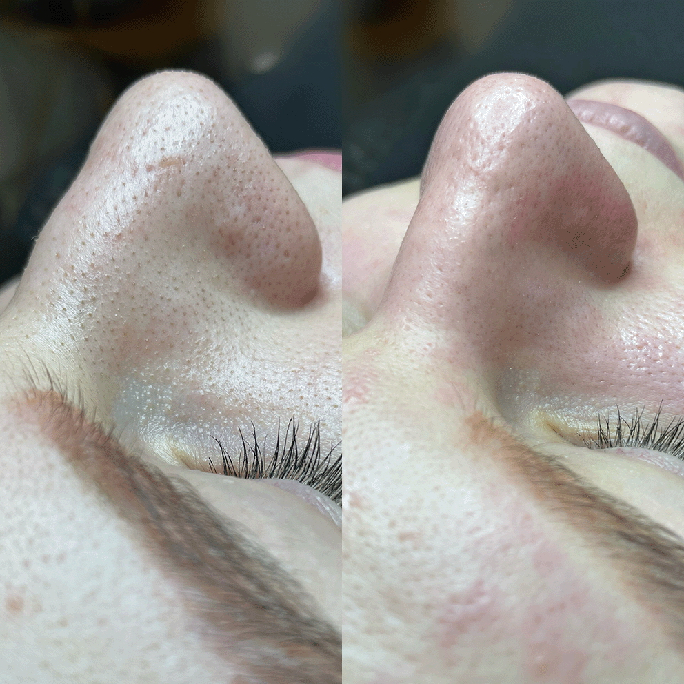 hydrafacial3