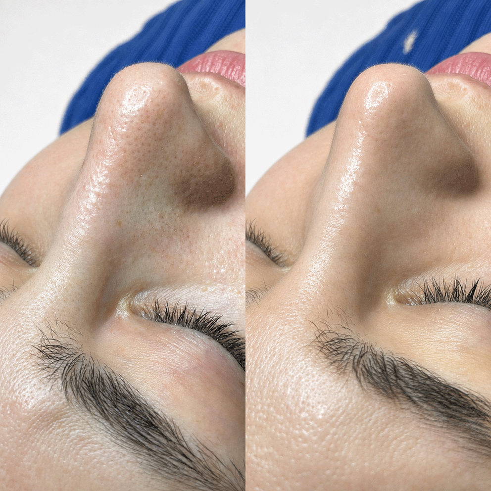 hydrafacial1