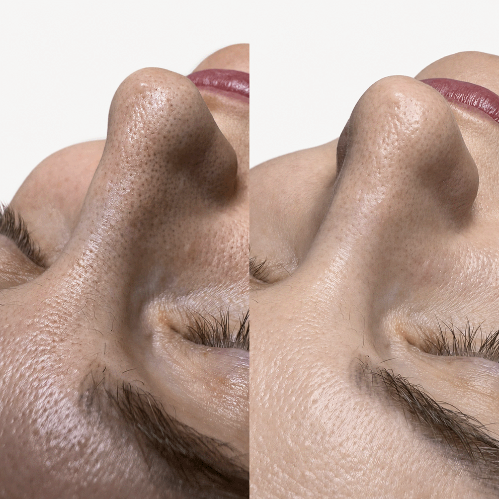 hydrafacial2