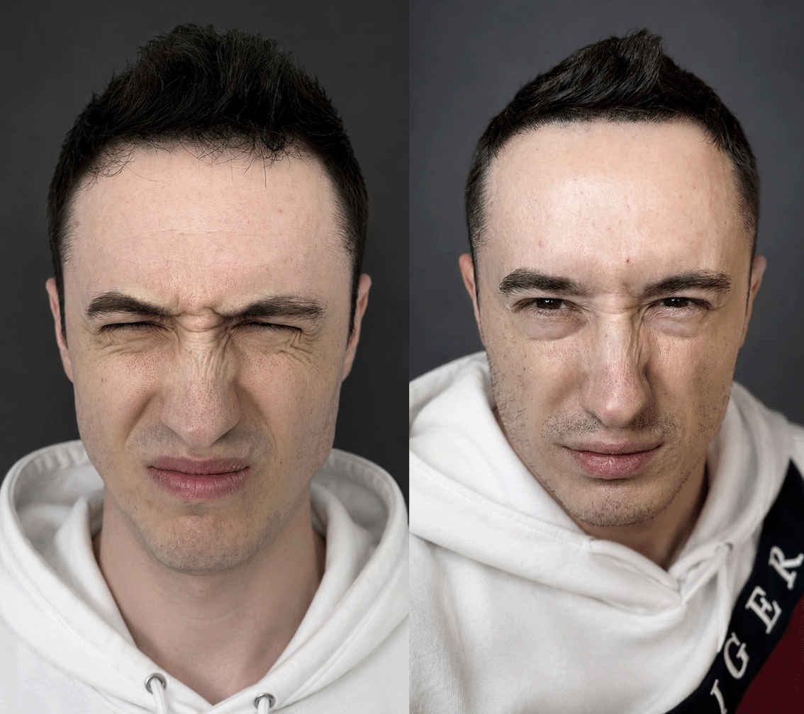 Ботулинотерапия
