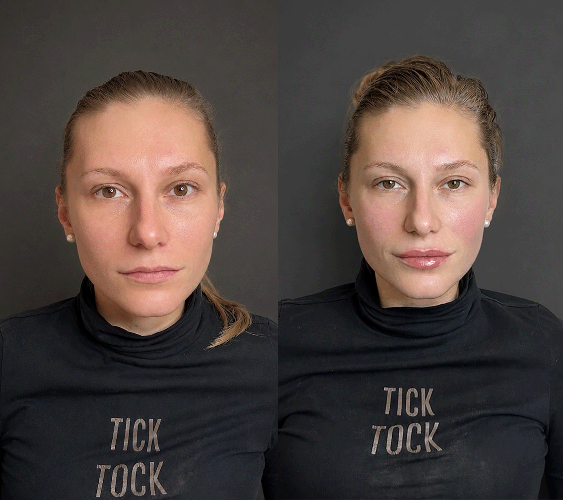 Пластика губ